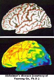 Maladie d'Alzheimer ( cerveaux)