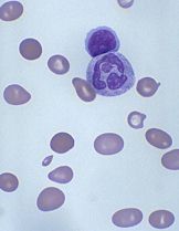 Histologie de la maladie de Biermer